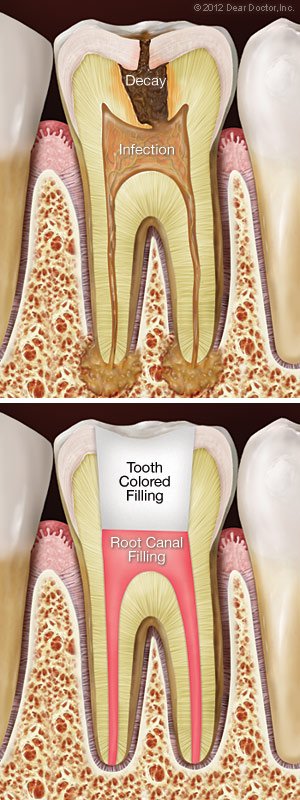 Root Canals | Dentist in St. Clair Shores, MI | Malouf Family Dentistry In St. Clair Shores, MI| Malouf Family Dentistry