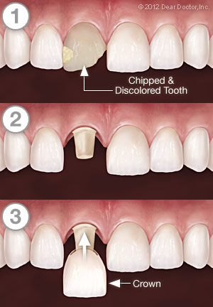 Dental Crowns Step by Step  St. Clair Shores, MI & Grosse Pointe Woods, MI