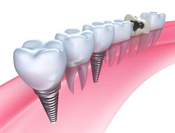 Implant Restoration, Dental Implants in Morgan and Sayreville, NJ